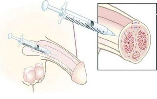 Injection d'injections d'acide hyaluronique