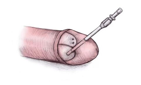 La tête du pénis peut être agrandie en injectant du gel hyaluronique.